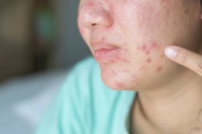close-up-of-asian-girl-skin-problem-cheek