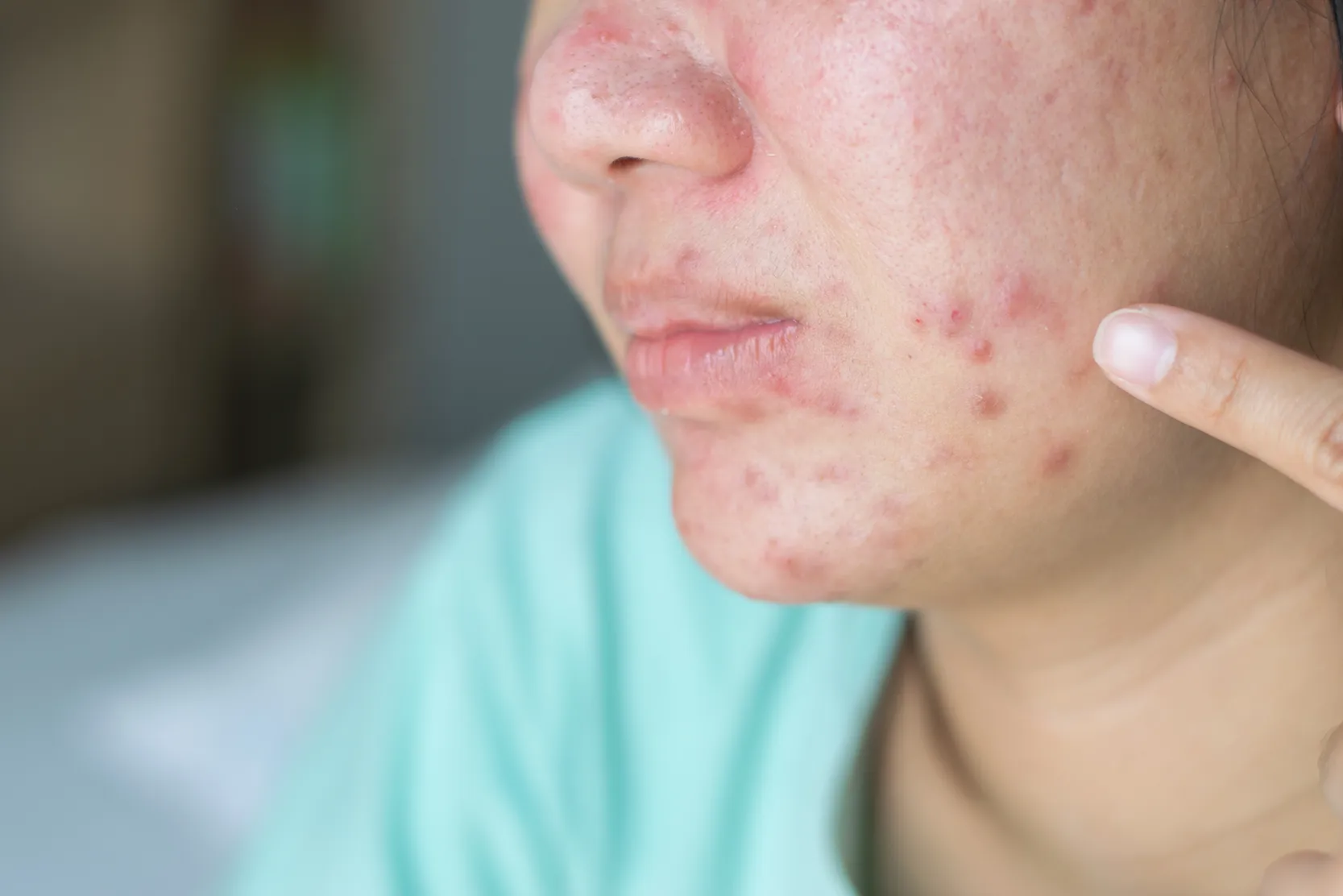 close-up-of-asian-girl-skin-problem-cheek